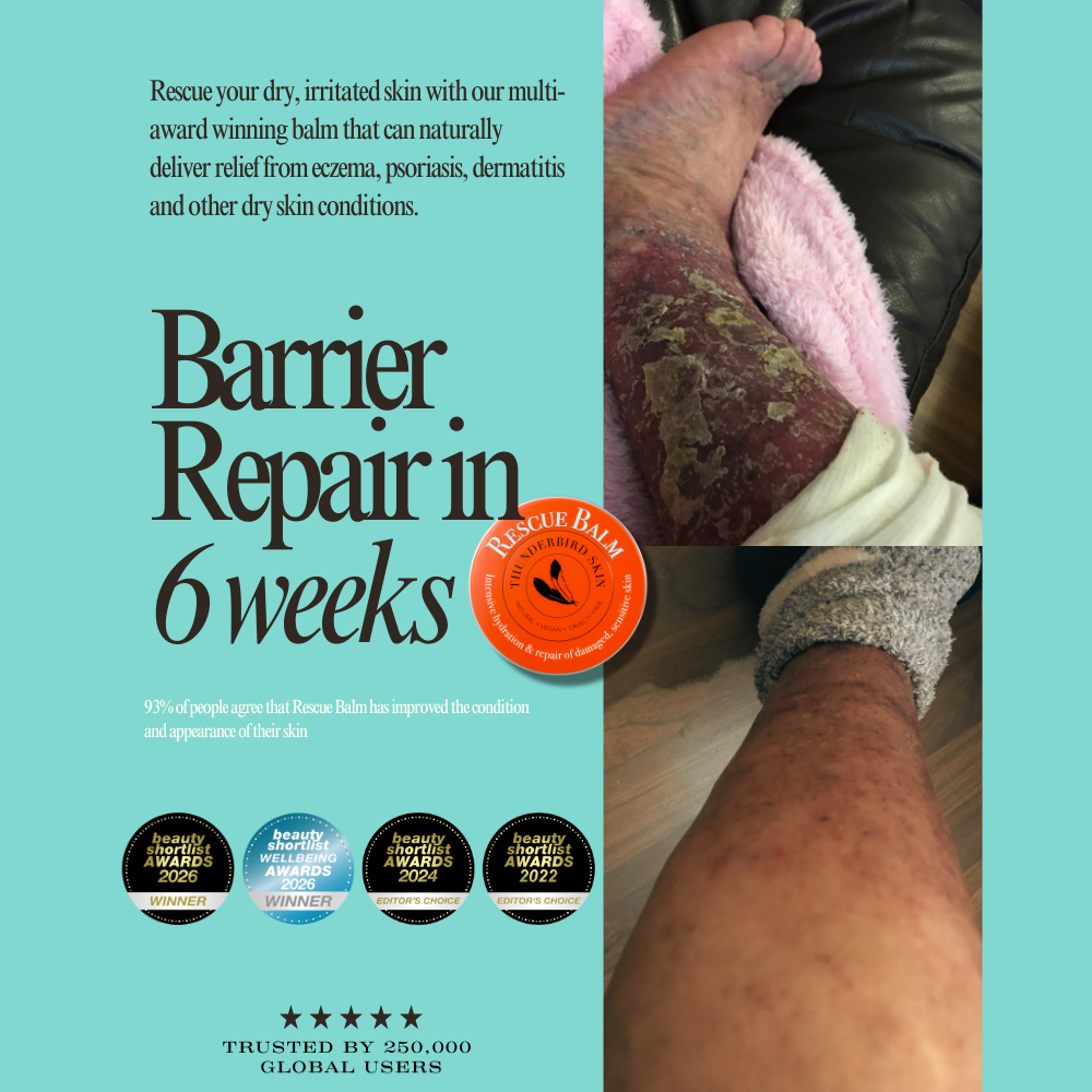 Rescue Balm for  hives and Irritated Skin