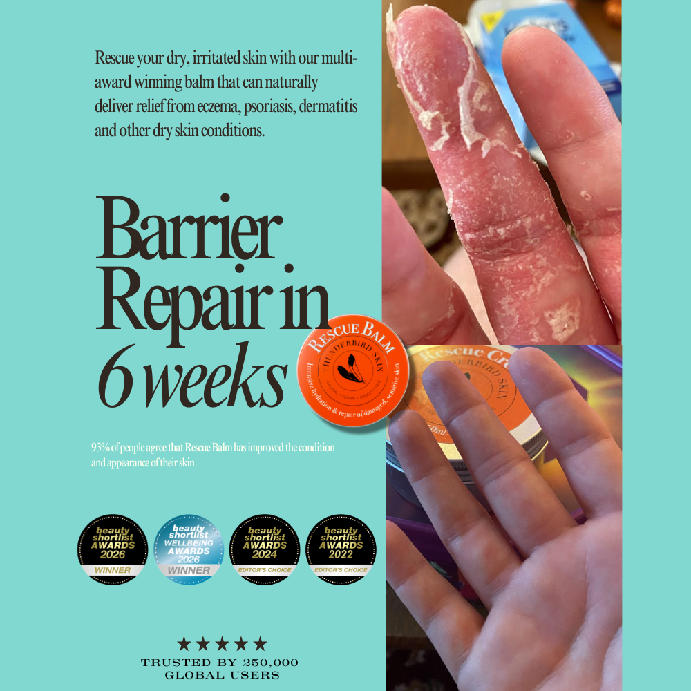 Rescue Balm for  hives and Irritated Skin